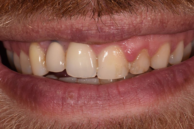 Patient Smile Before & After Gallery - Patient 138933 - Image 3