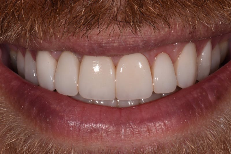 Patient Smile Before & After Gallery - Patient 138933 - Image 4
