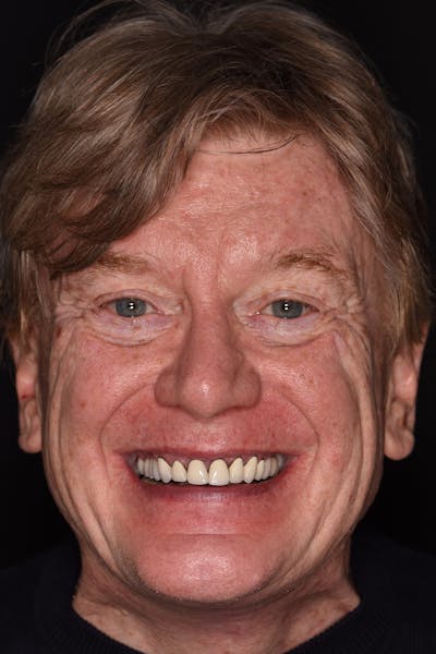 Patient Smile Before & After Gallery - Patient 374603 - Image 1