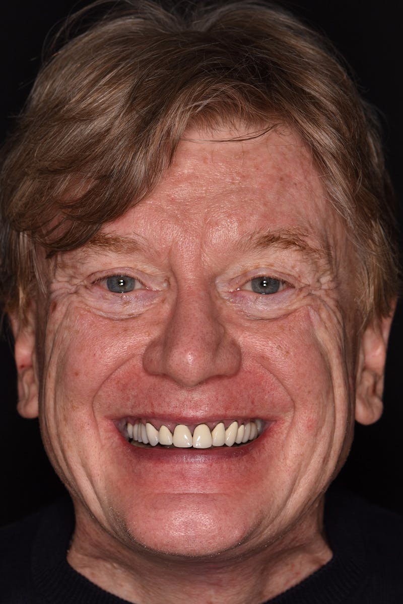 Patient Smile Before & After Gallery - Patient 374603 - Image 1