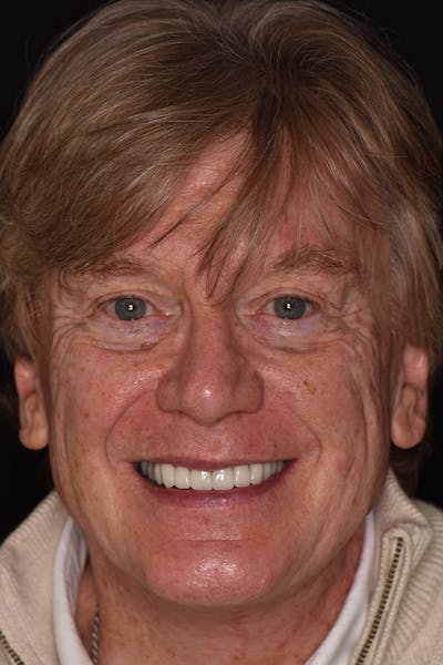 Patient Smile Before & After Gallery - Patient 374603 - Image 2