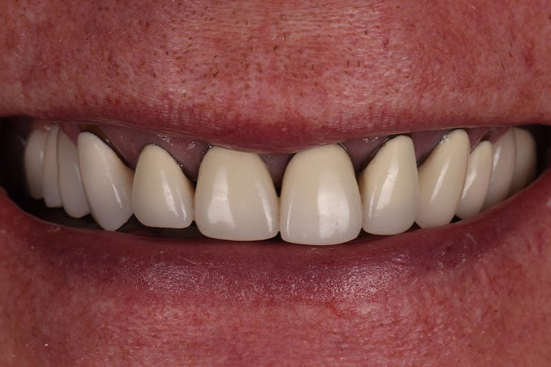 Patient Smile Before & After Gallery - Patient 374603 - Image 3