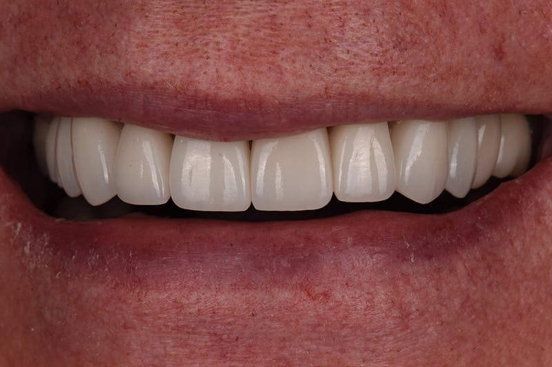 Patient Smile Before & After Gallery - Patient 374603 - Image 4