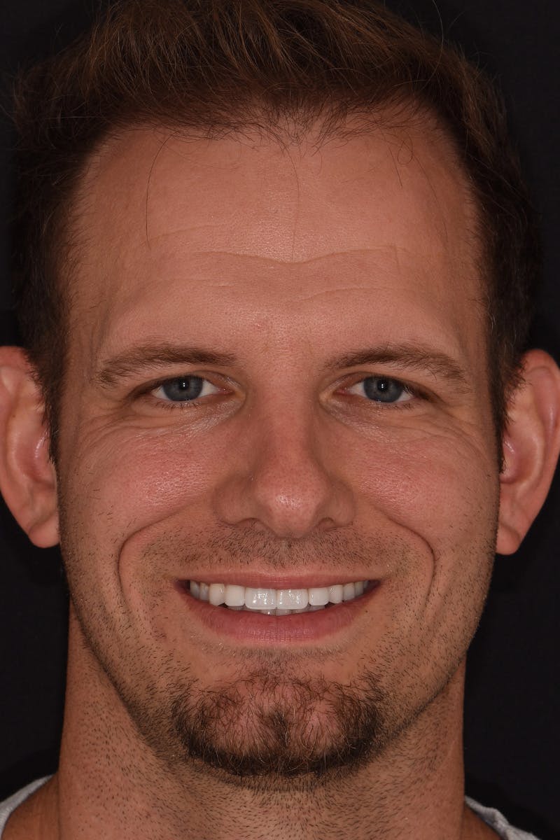 Patient Smile Before & After Gallery - Patient 342069 - Image 1
