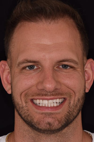 Patient Smile Before & After Gallery - Patient 342069 - Image 2