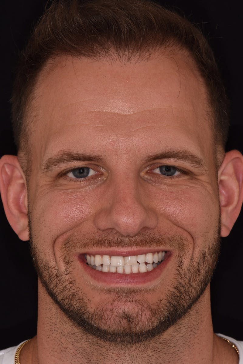Patient Smile Before & After Gallery - Patient 342069 - Image 2