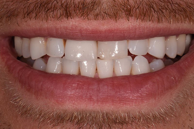 Patient Smile Before & After Gallery - Patient 342069 - Image 3