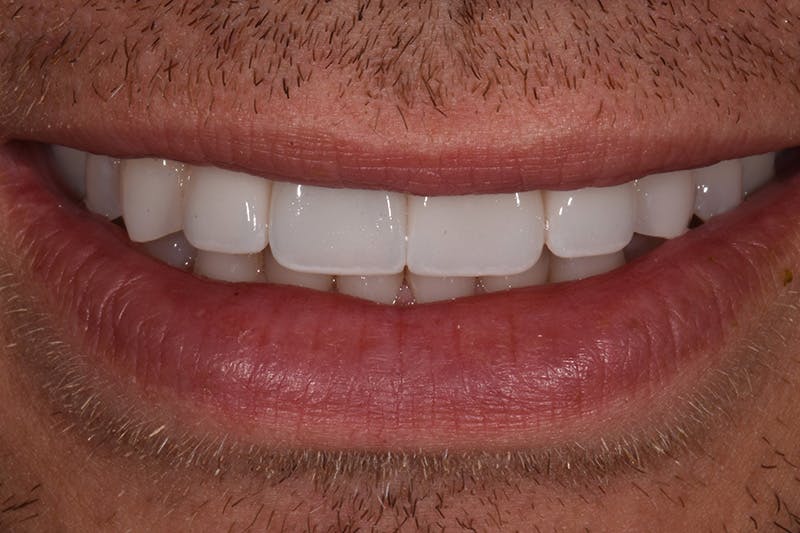 Patient Smile Before & After Gallery - Patient 342069 - Image 4