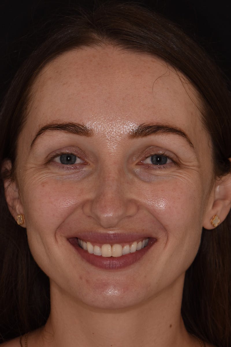 Patient Smile Before & After Gallery - Patient 165690 - Image 1