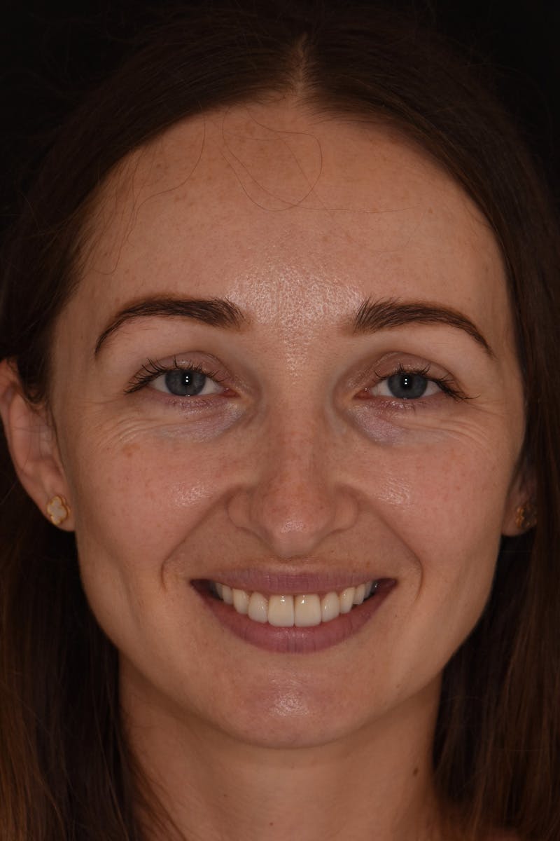 Patient Smile Before & After Gallery - Patient 165690 - Image 2