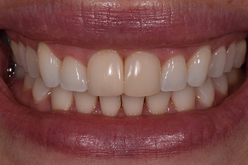 Patient Smile Before & After Gallery - Patient 165690 - Image 3
