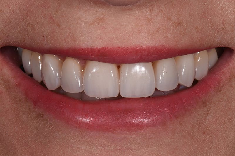 Patient Smile Before & After Gallery - Patient 165690 - Image 4