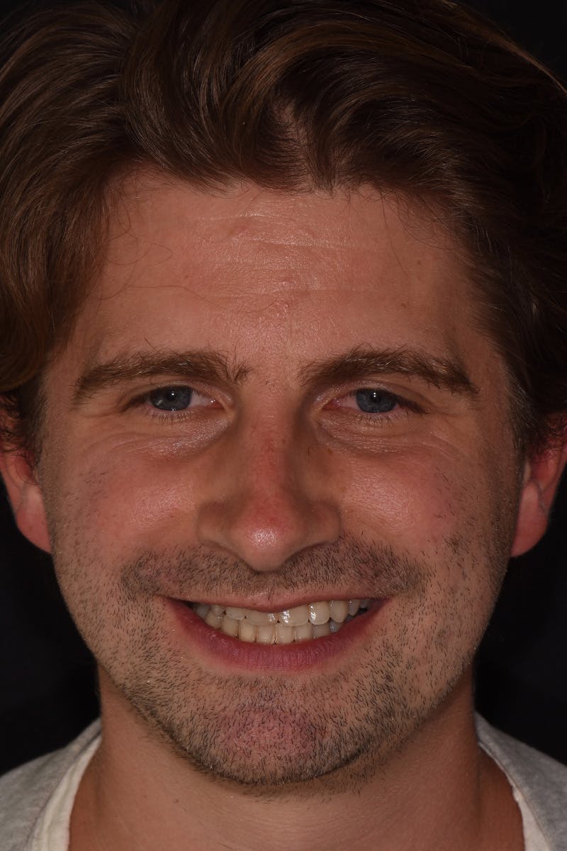 Patient Smile Before & After Gallery - Patient 128870 - Image 1
