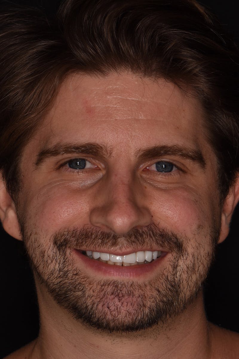 Patient Smile Before & After Gallery - Patient 128870 - Image 2