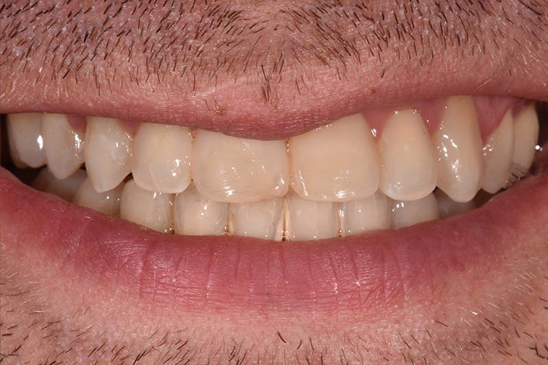 Patient Smile Before & After Gallery - Patient 128870 - Image 3