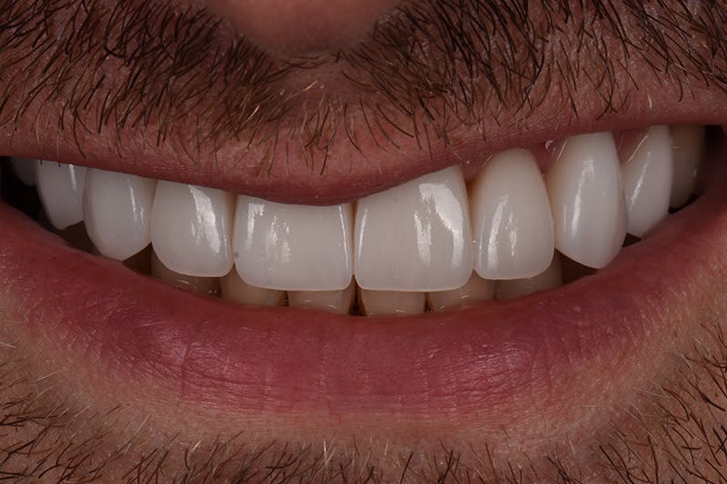 Patient Smile Before & After Gallery - Patient 128870 - Image 4