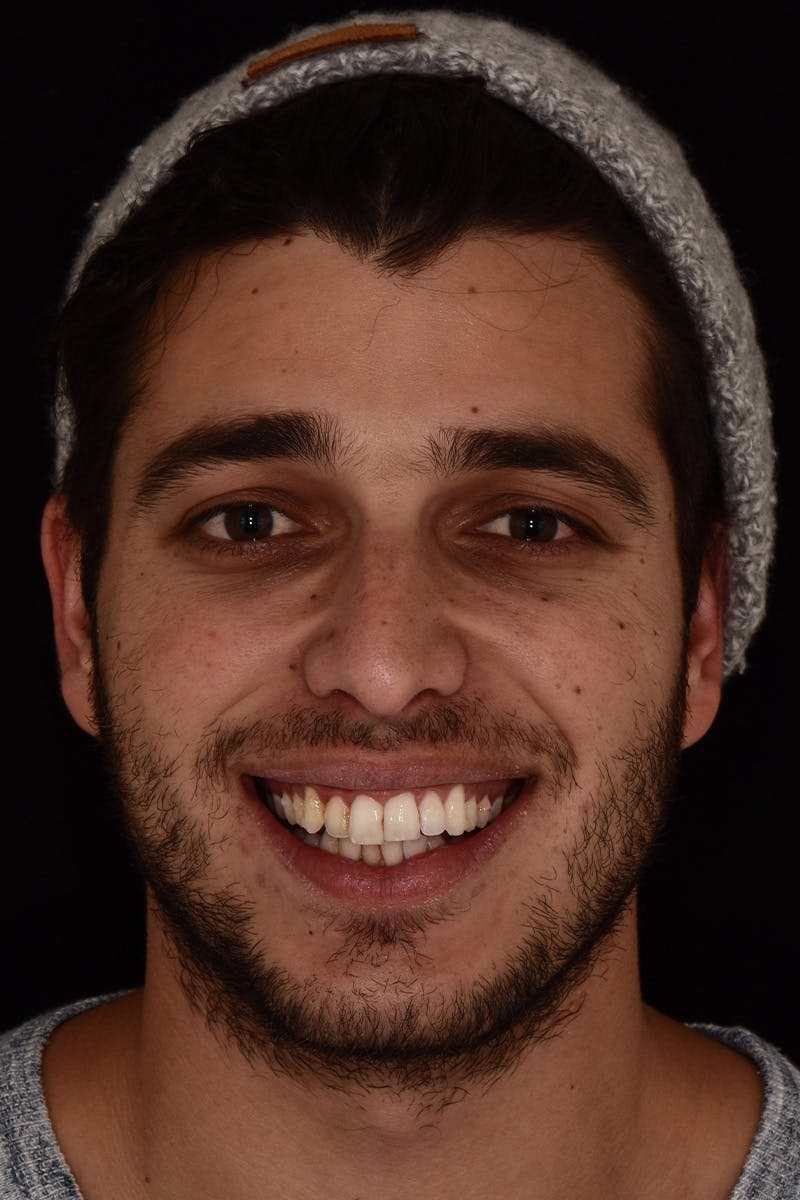 Patient Smile Before & After Gallery - Patient 102871 - Image 1