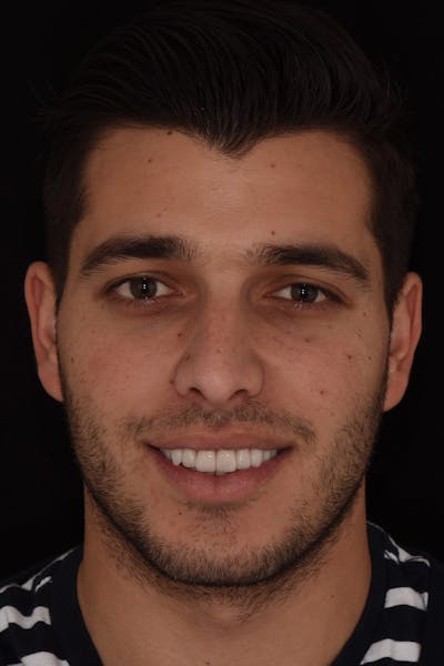 Patient Smile Before & After Gallery - Patient 102871 - Image 2