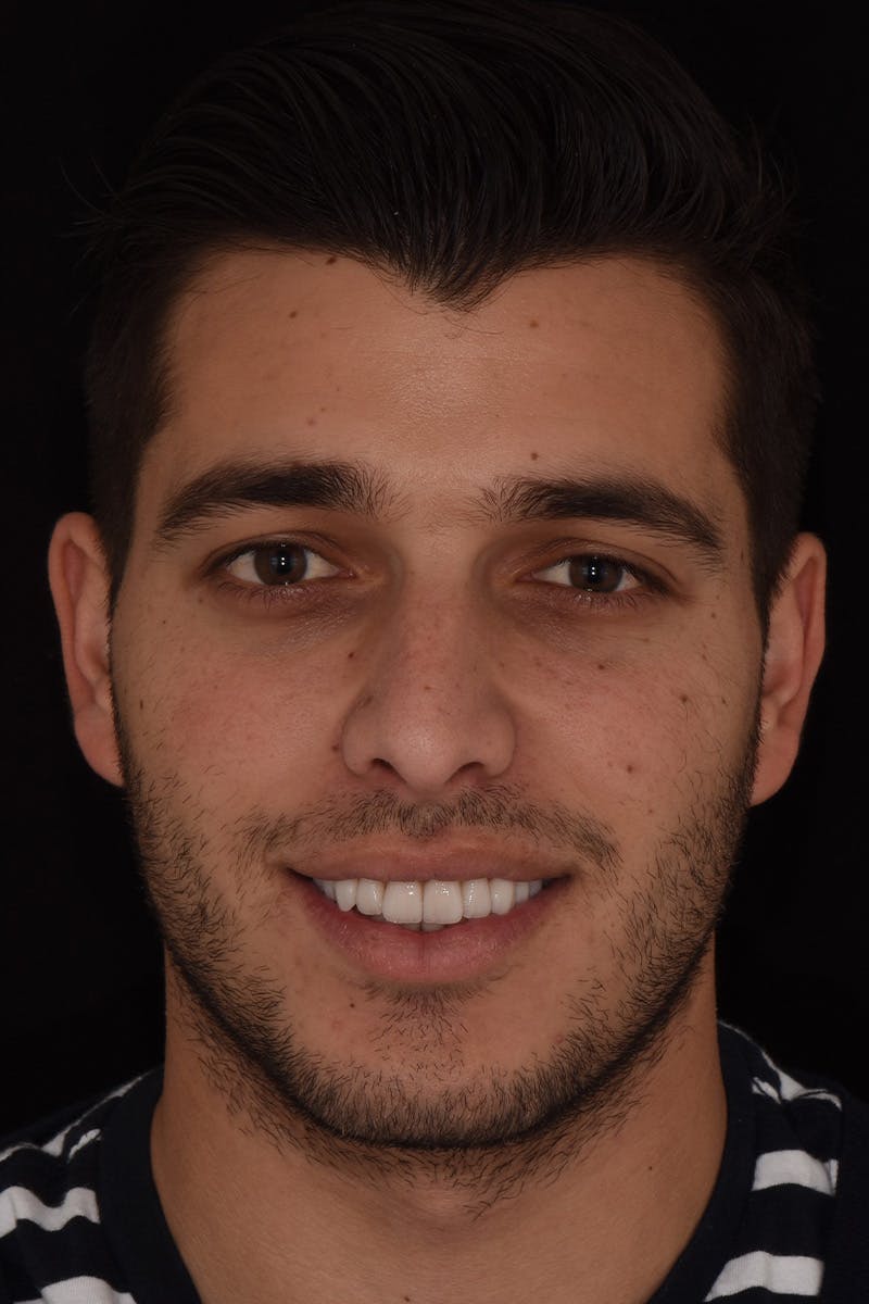 Patient Smile Before & After Gallery - Patient 102871 - Image 2