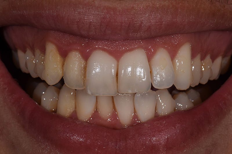 Patient Smile Before & After Gallery - Patient 102871 - Image 3