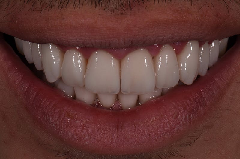 Patient Smile Before & After Gallery - Patient 102871 - Image 4