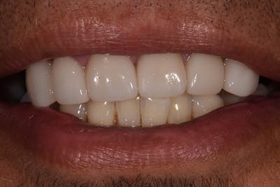 Patient Smile Before & After Gallery - Patient 180811 - Image 1