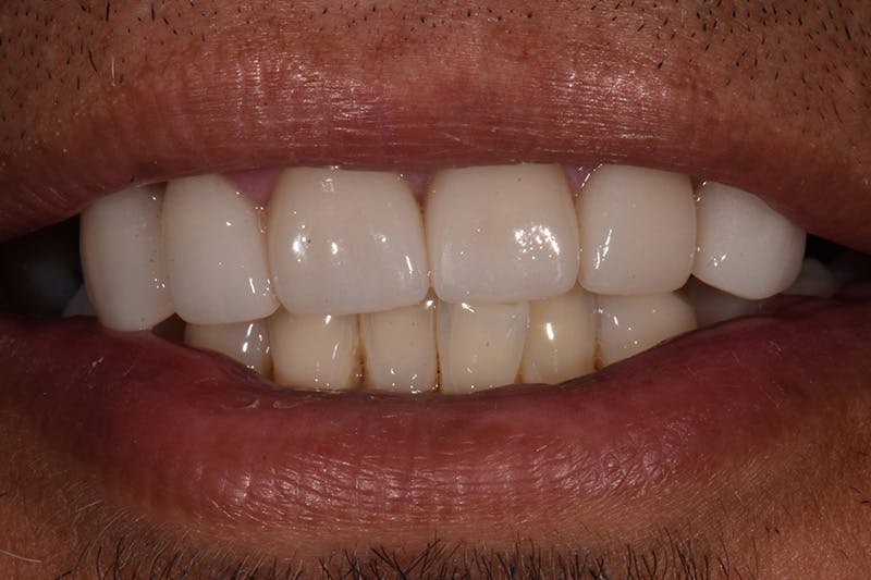 Patient Smile Before & After Gallery - Patient 180811 - Image 1
