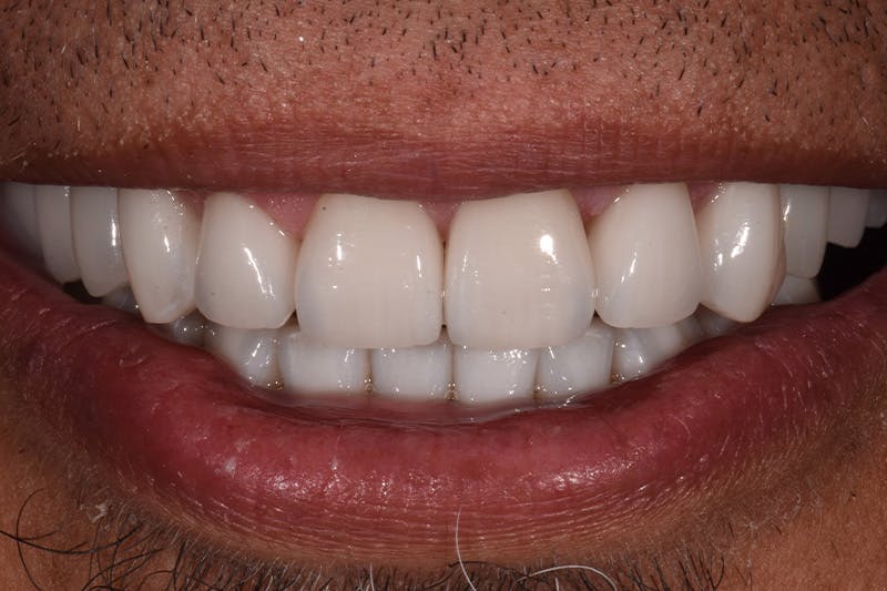 Patient Smile Before & After Gallery - Patient 180811 - Image 2
