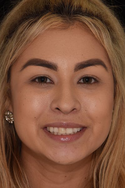 Patient Smile Before & After Gallery - Patient 267417 - Image 1