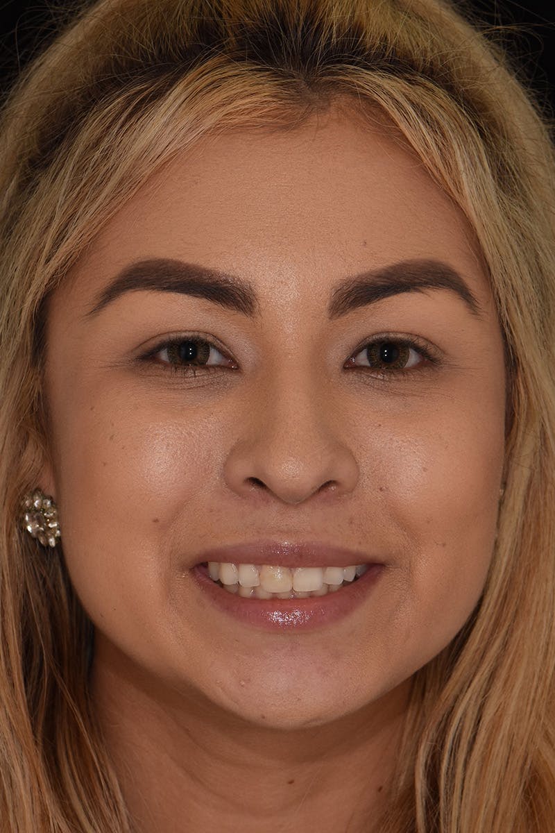 Patient Smile Before & After Gallery - Patient 267417 - Image 1