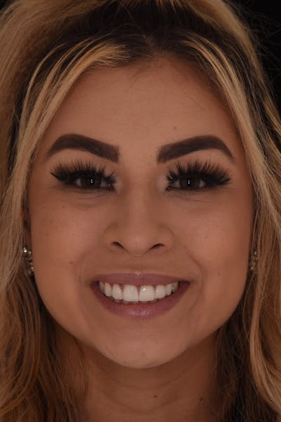 Patient Smile Before & After Gallery - Patient 267417 - Image 2