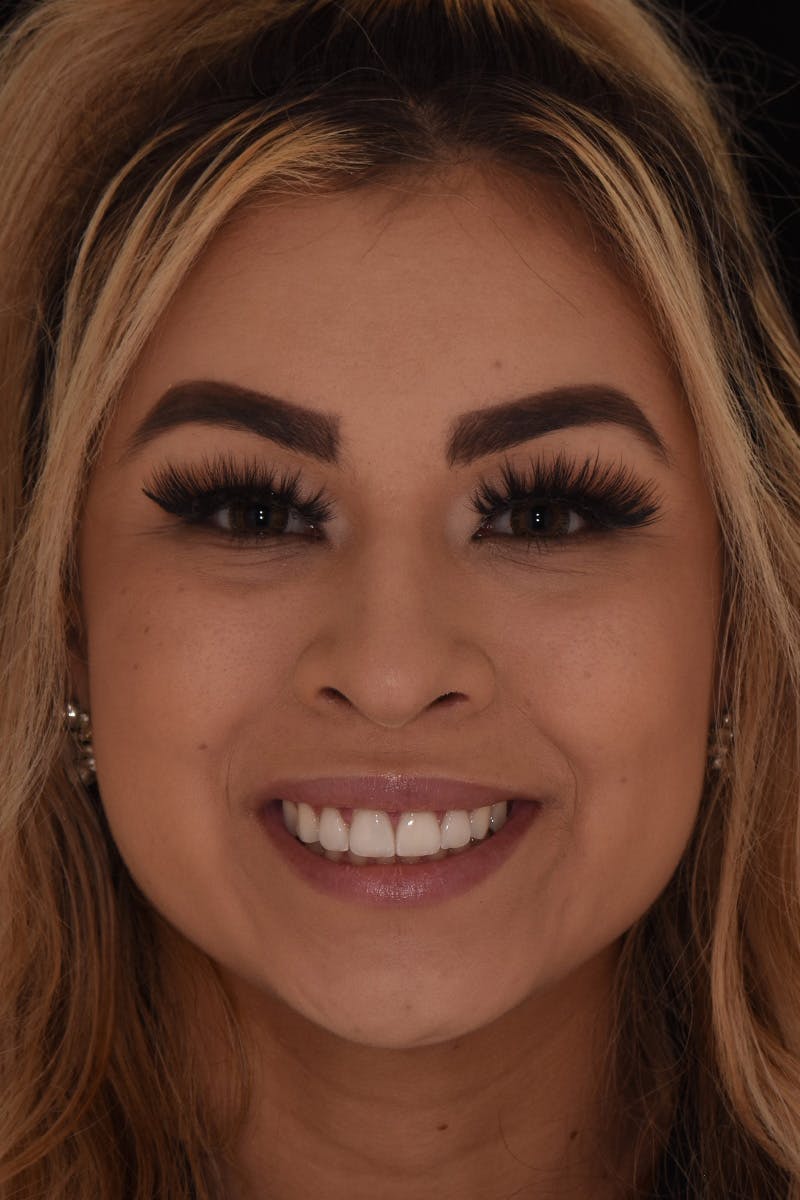 Patient Smile Before & After Gallery - Patient 267417 - Image 2