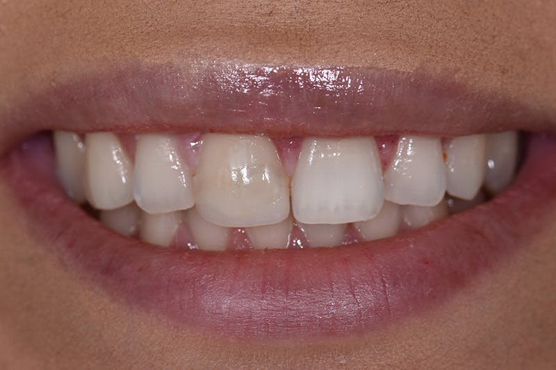 Patient Smile Before & After Gallery - Patient 267417 - Image 3