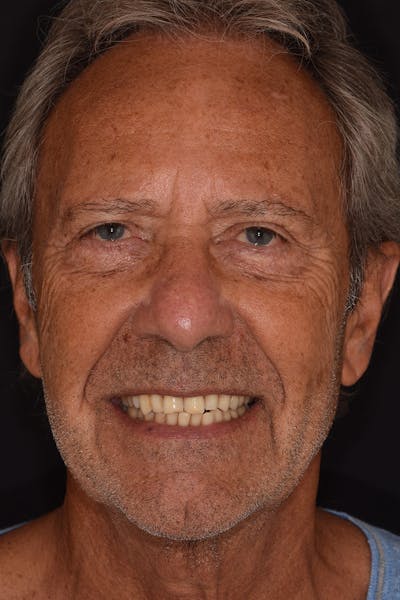 Patient Smile Before & After Gallery - Patient 372472 - Image 1