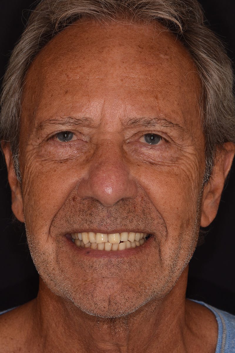 Patient Smile Before & After Gallery - Patient 372472 - Image 1