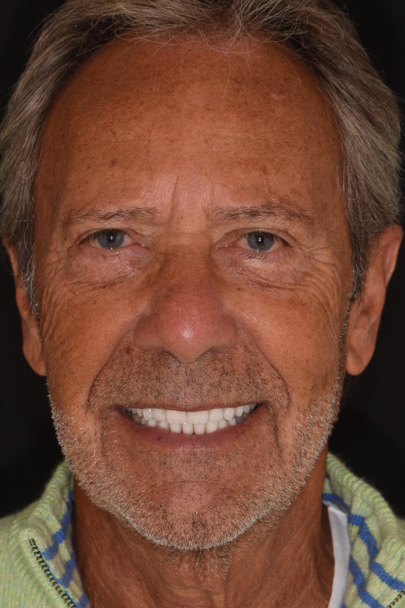 Patient Smile Before & After Gallery - Patient 372472 - Image 2