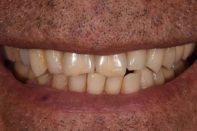 Patient Smile Before & After Gallery - Patient 372472 - Image 3
