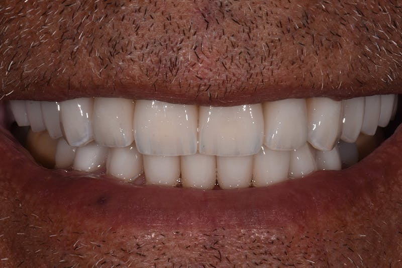 Patient Smile Before & After Gallery - Patient 372472 - Image 4