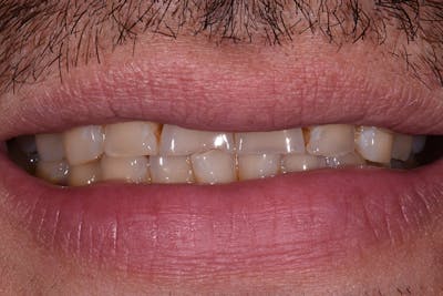 Patient Smile Before & After Gallery - Patient 932147 - Image 1