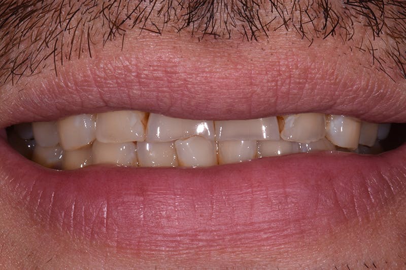 Patient Smile Before & After Gallery - Patient 932147 - Image 1