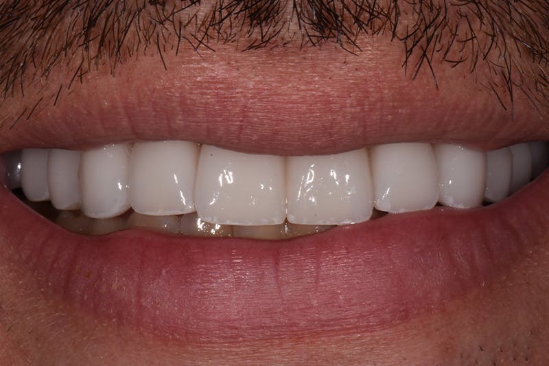 Patient Smile Before & After Gallery - Patient 932147 - Image 2
