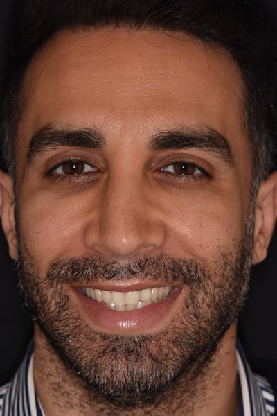 Patient Smile Before & After Gallery - Patient 972928 - Image 1