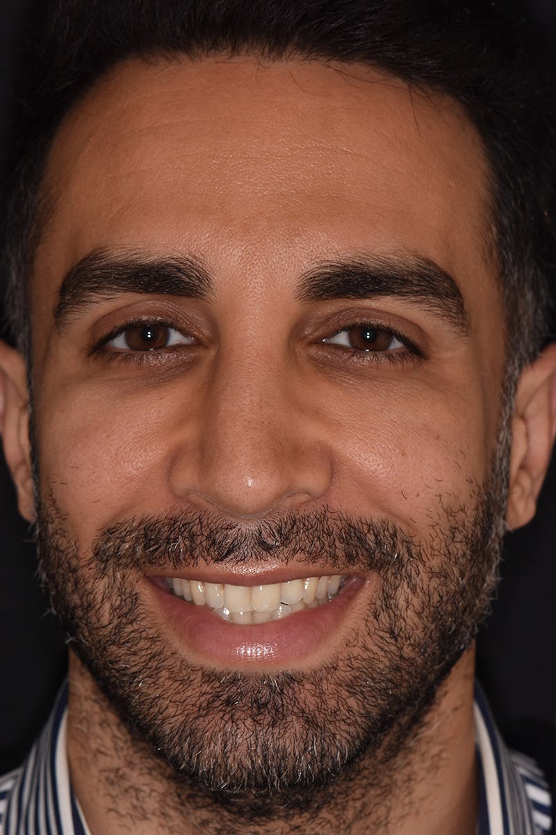 Patient Smile Before & After Gallery - Patient 972928 - Image 1