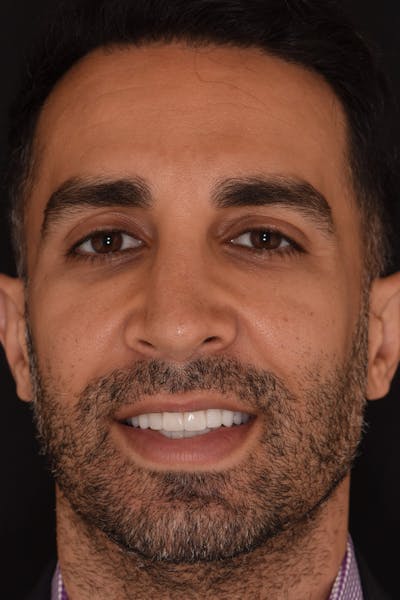 Patient Smile Before & After Gallery - Patient 972928 - Image 2