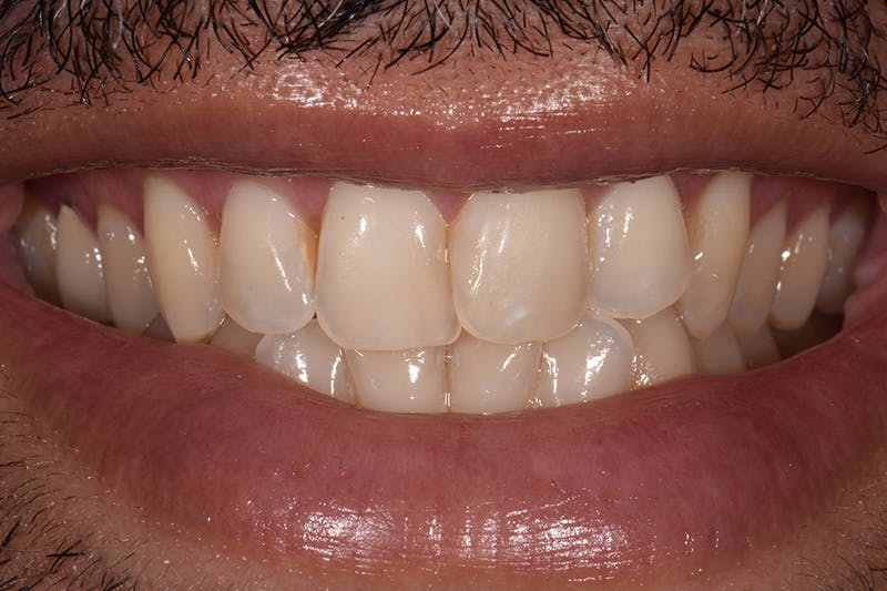 Patient Smile Before & After Gallery - Patient 972928 - Image 3