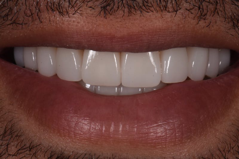 Patient Smile Before & After Gallery - Patient 972928 - Image 4