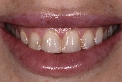 Patient Smile Before & After Gallery - Patient 365222 - Image 1