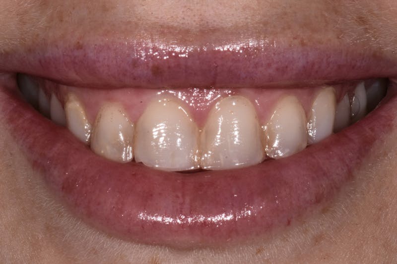Patient Smile Before & After Gallery - Patient 365222 - Image 1