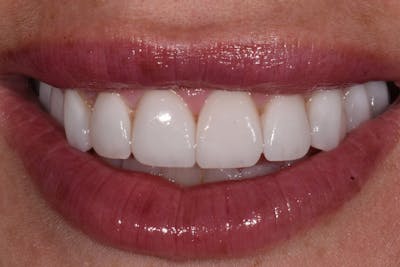 Patient Smile Before & After Gallery - Patient 365222 - Image 2