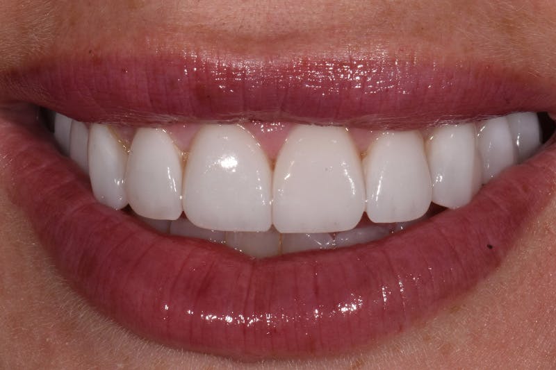 Patient Smile Before & After Gallery - Patient 365222 - Image 2
